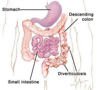 imagine cu ocluzie intestinala